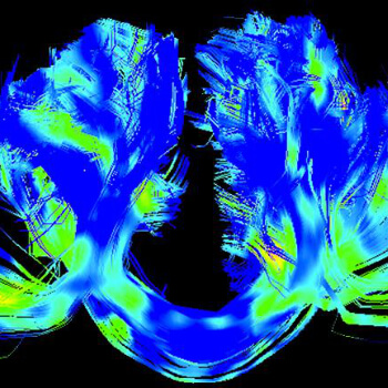 Image for Slow-moving shell of water can make Parkinson’s proteins ‘stickier’
